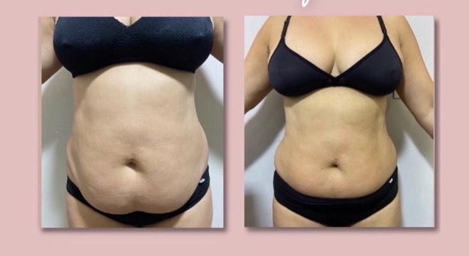Antes e depois de frente: barriga de uma aluna antes e depois do desafio