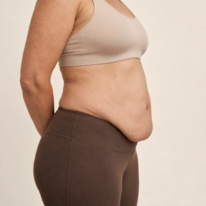 Barriga com flacidez e dobra na parte inferior