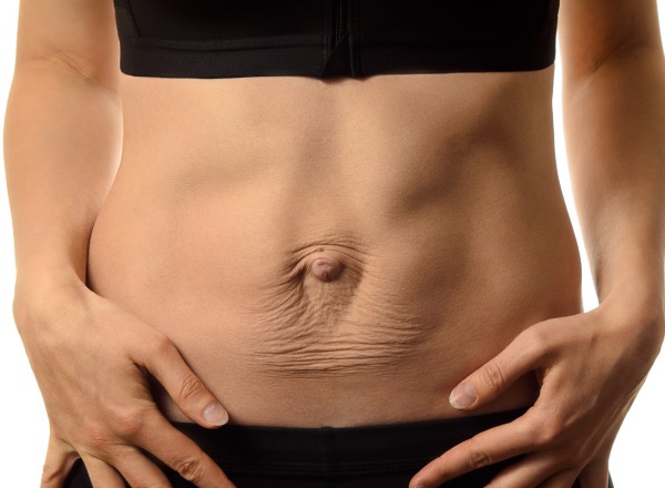 Barriga de mulher depois da gravidez, com a linha de diástase visível